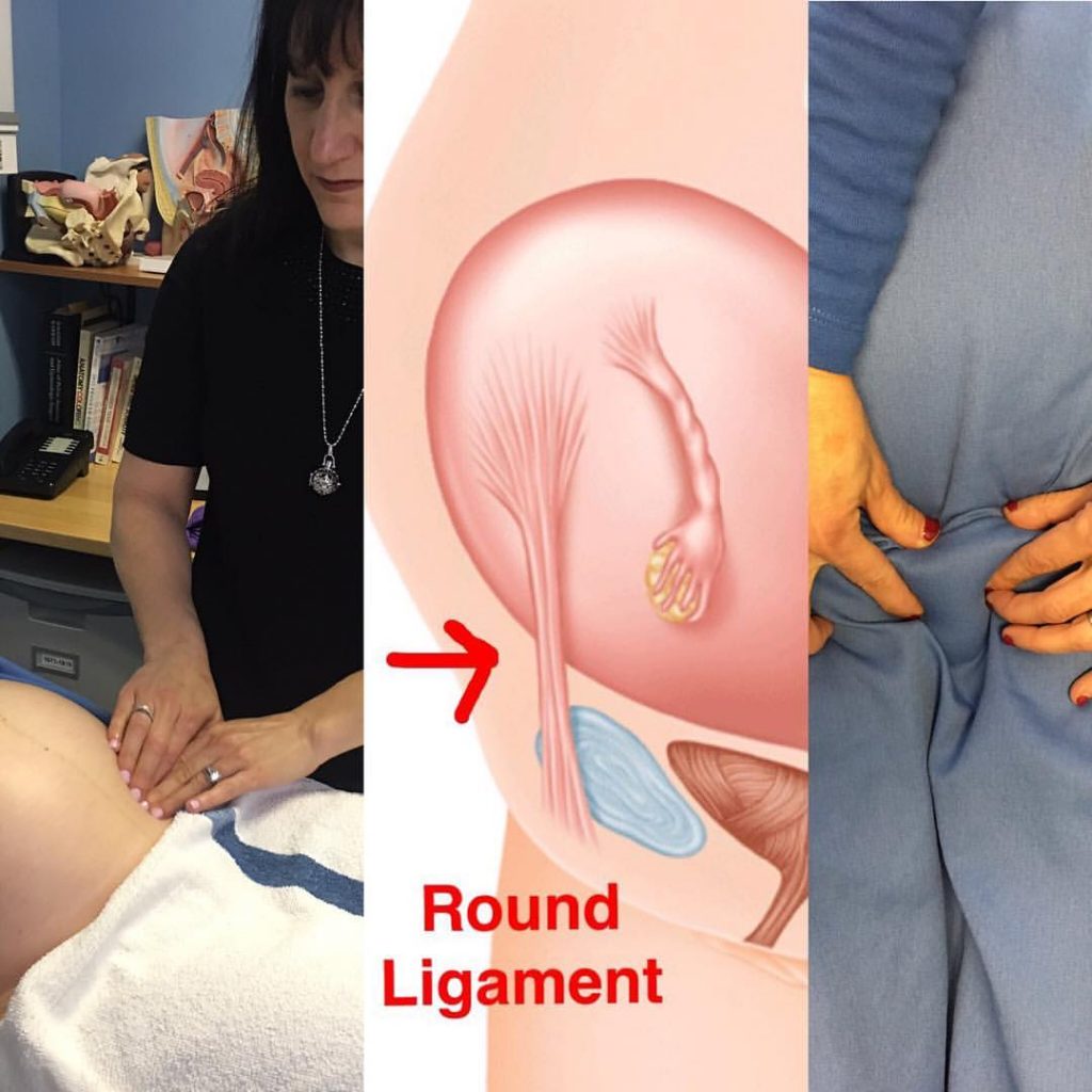 Round Ligament Pain in Pregnancy - Pamela Morrison Pelvic Pain Physical