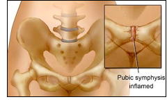 Symphysis Pubis Dysfunction And Prenatal Massage - Maternal Massage