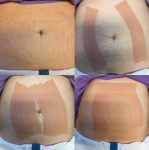 Supportive Taping for Postpartum Belly Stretch Marks - Pamela